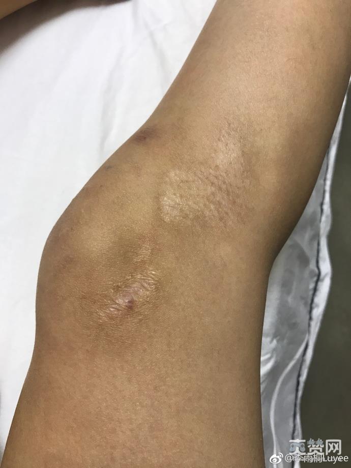 网红曝被薛之谦骗 李雨桐又曝新料称当年出车祸薛之谦隐瞒真相